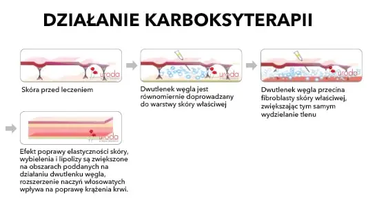 działanie karboksyterapii na cellulit