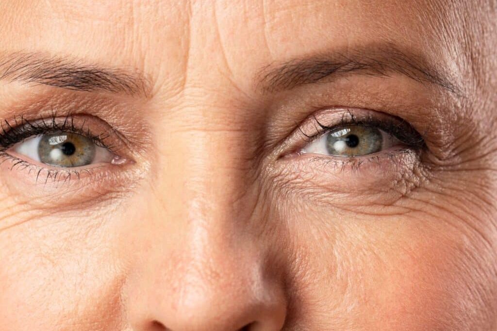 Zmarszczki pod oczami - przyczyny powstawania, zabiegi i sposoby redukcji | RosaMed Clinic