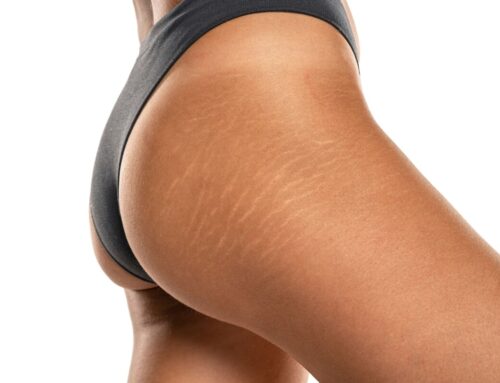 Rozstępy na pośladkach – przyczyny powstawania i pielęgnacja